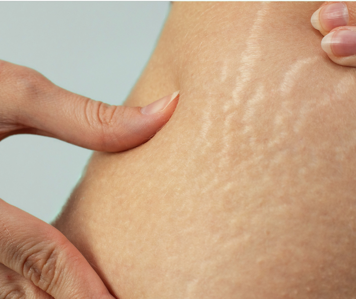 Natural Remedies for Stretch Marks That Really Work!