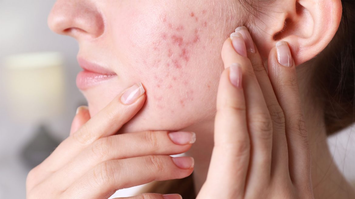 Woman with stress acne