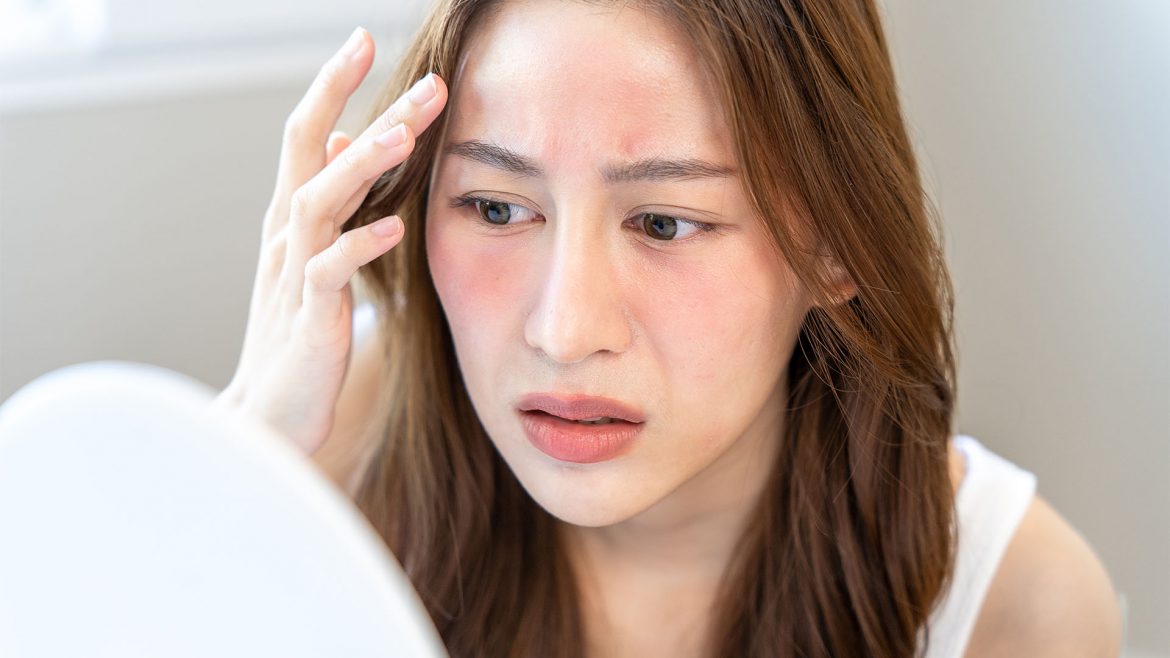 Woman suffering from possible side effect of kojic acid