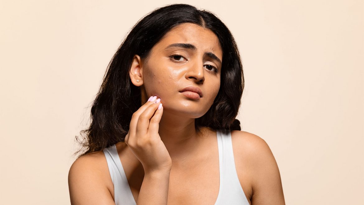 Woman with stress acne