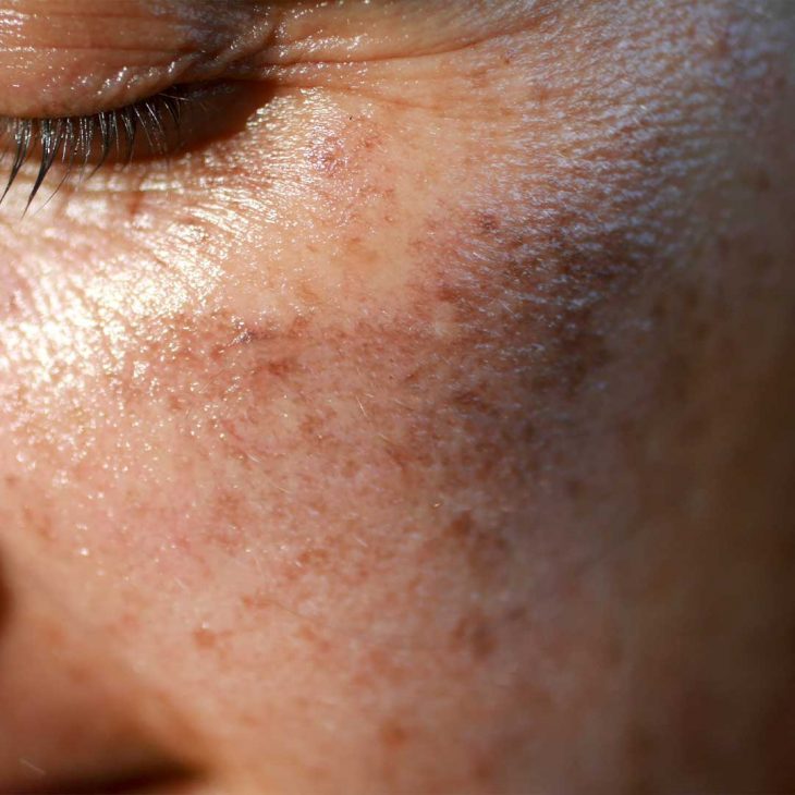 Woman with pigmented skin