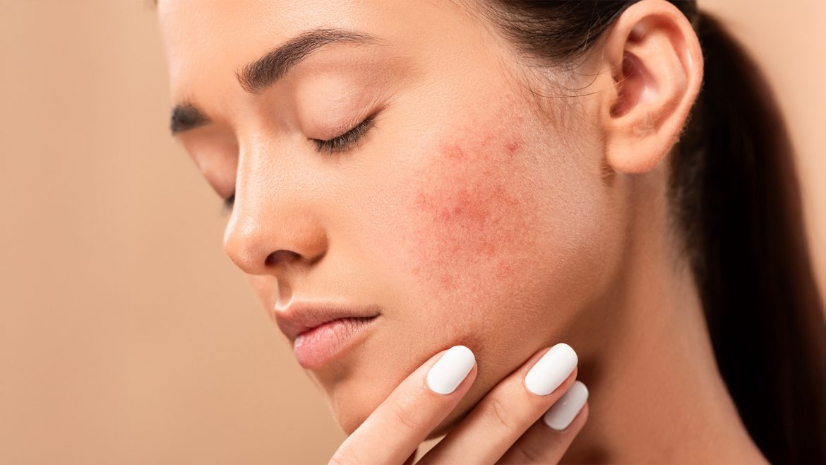 Peptides for Sensitive and Acne-Prone Skin